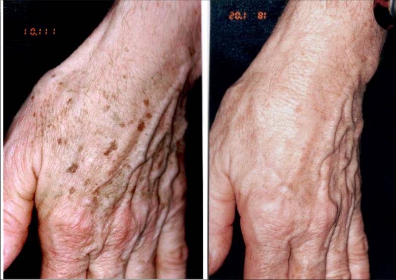 Freckles & Liver spots hands